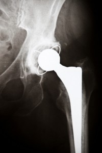 An X-ray of a hip replacement. Credit: Shutterstock